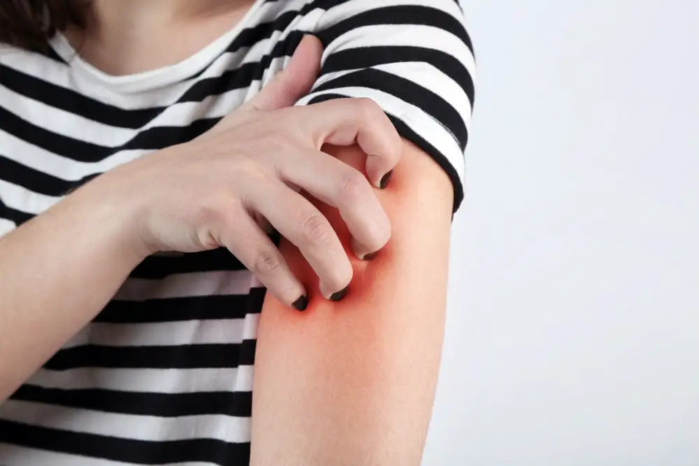 Allergies concept. Woman scratching arm, closeup