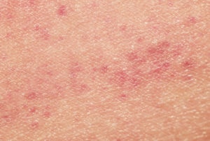 sick human skin texture covered with red allergic spots and irritations